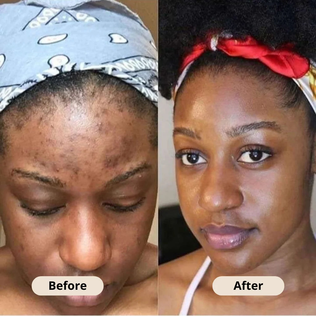 Kojic Acid Turmeric Soap